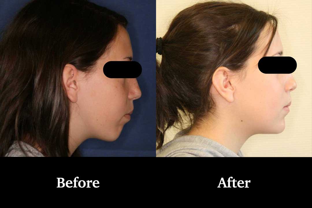 Genioplasty in Dubai – Recontouring Your Chin for Facial Harmony