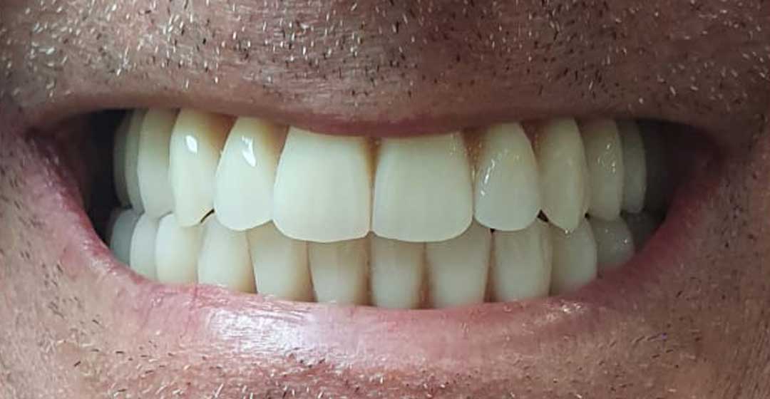After dental implants
