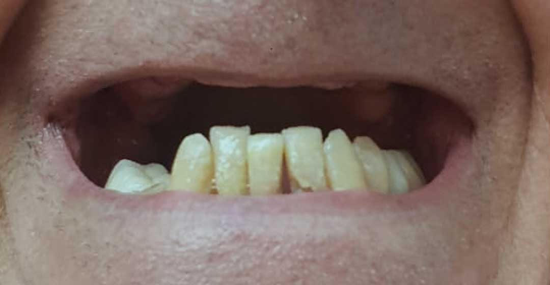Before dental implants