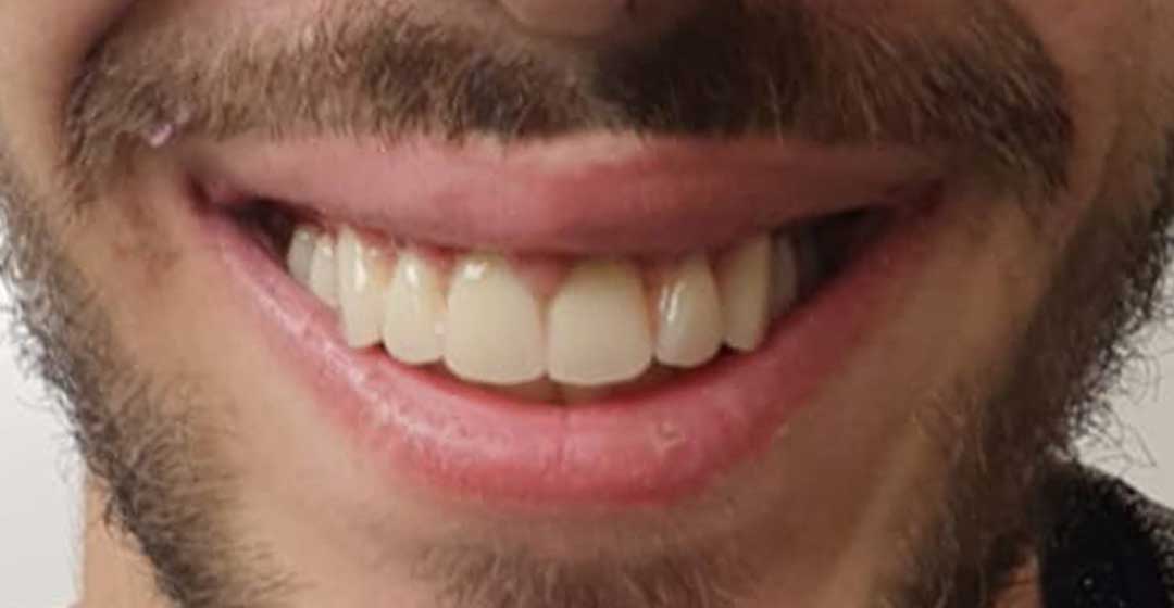 After dental implants