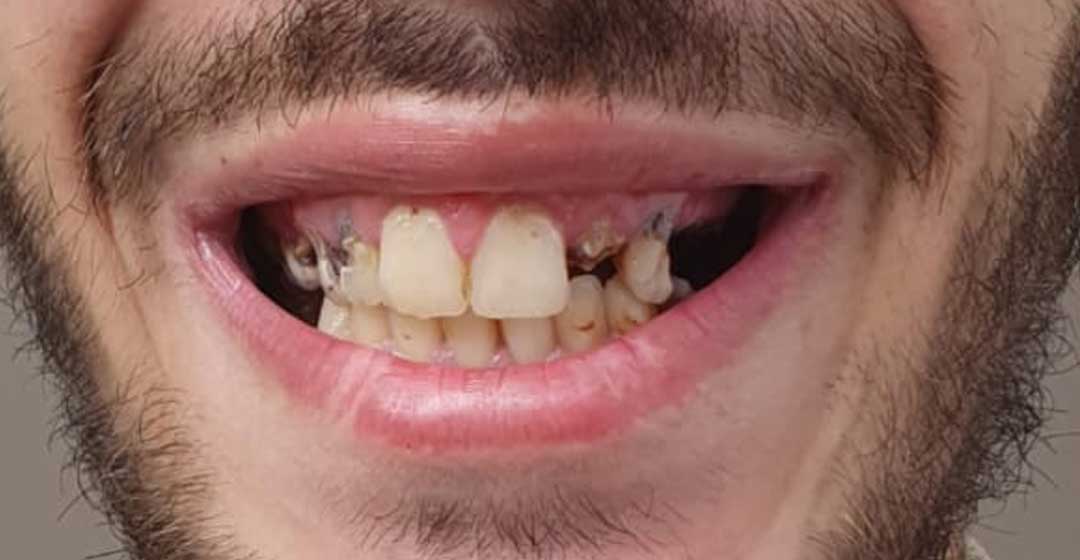 Before dental implants