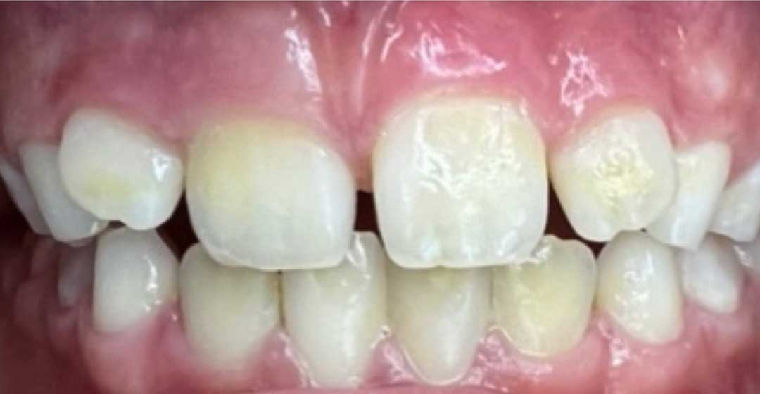 After dental braces treatment