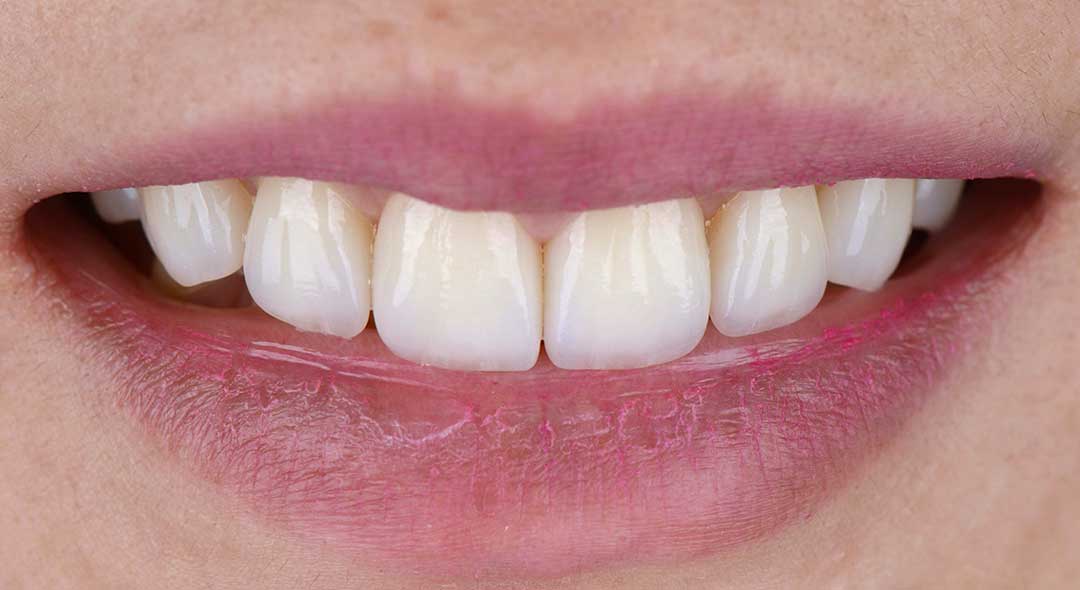 After Porcelain Veneers