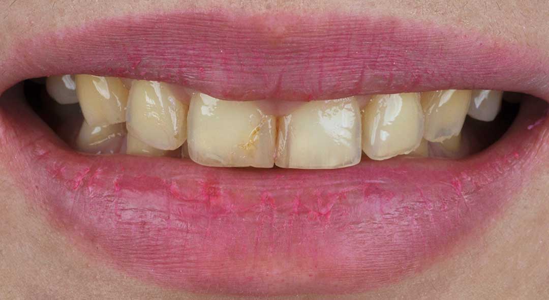 Before veneers